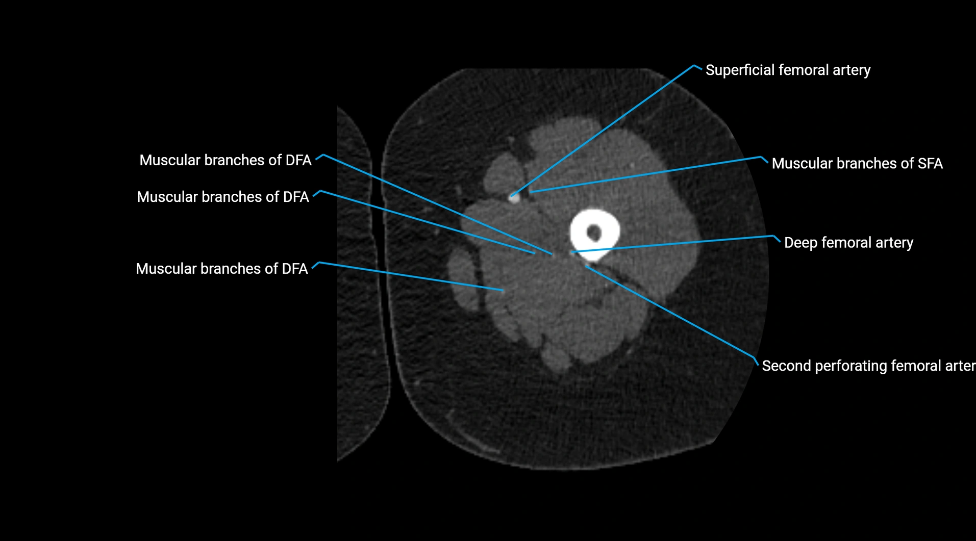CTA lower limb cross sectional anatomy labelled image _111.webp